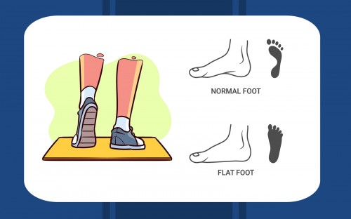 10 ویژگی مهم کفش و کتونی مناسب افرادی که کف پا صاف دارند